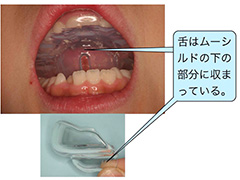 ムーシールド
