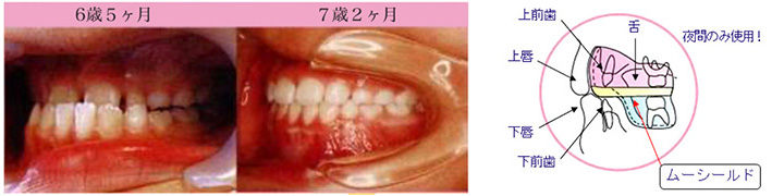 ムーシールド