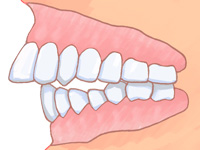 不正咬合