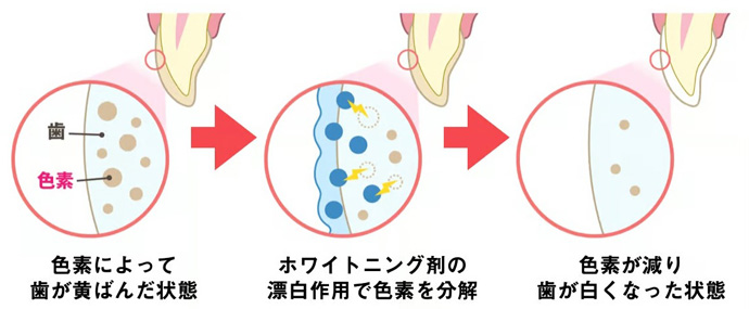 ホワイトニング